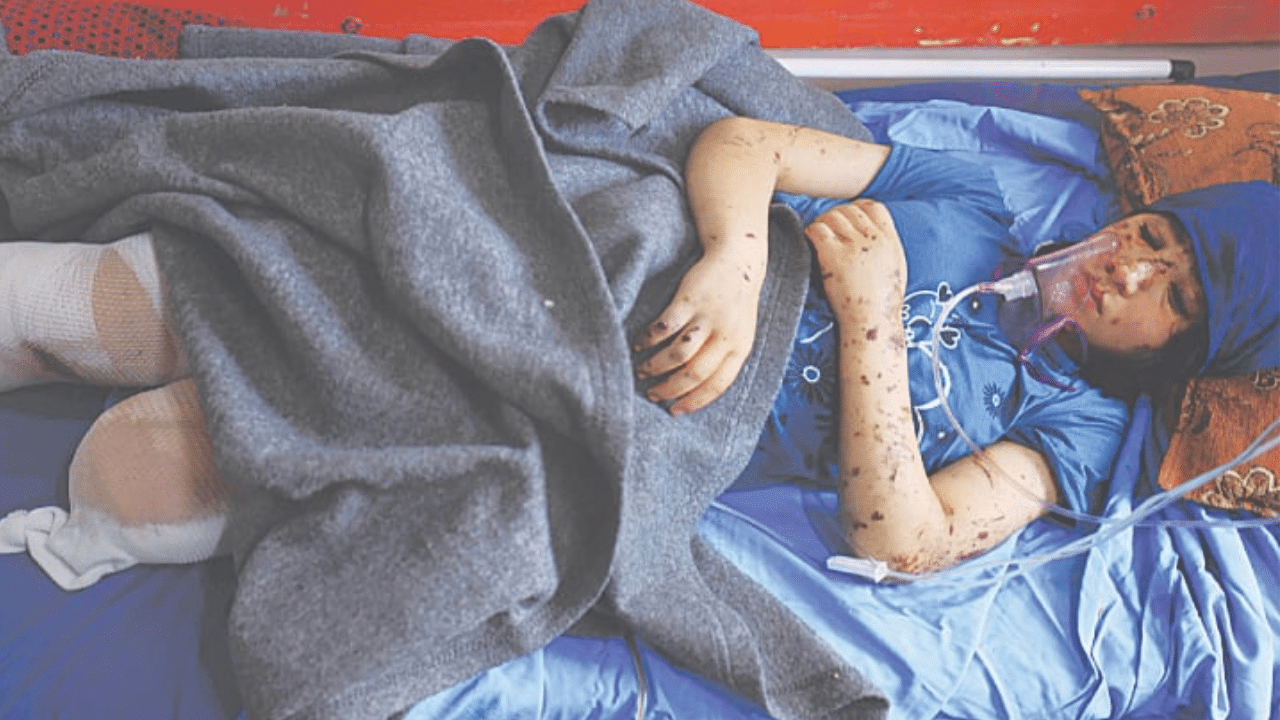 Over 1,000 Children in Gaza Have Had One or Both Legs Amputated Since Oct. 7